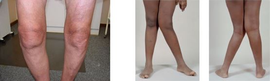 X- und O-Bein  -  Beinachsenfehlstellungen - Beinachsenkorrektur